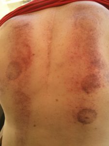 cuppping therapy on john duthie as part of chronic pain management - the cups leave red marks and look like pepperoni pizza